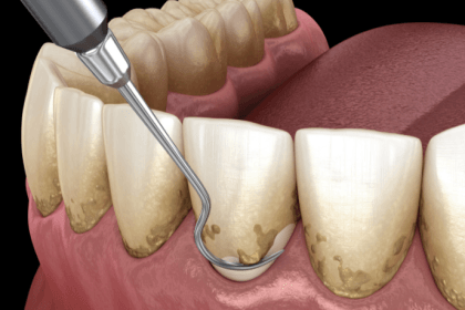 Resumo do Livro Carranza 's Clinical Periodontology de Michael G. Newman e Henry H. Takei - Periodontia Clínica